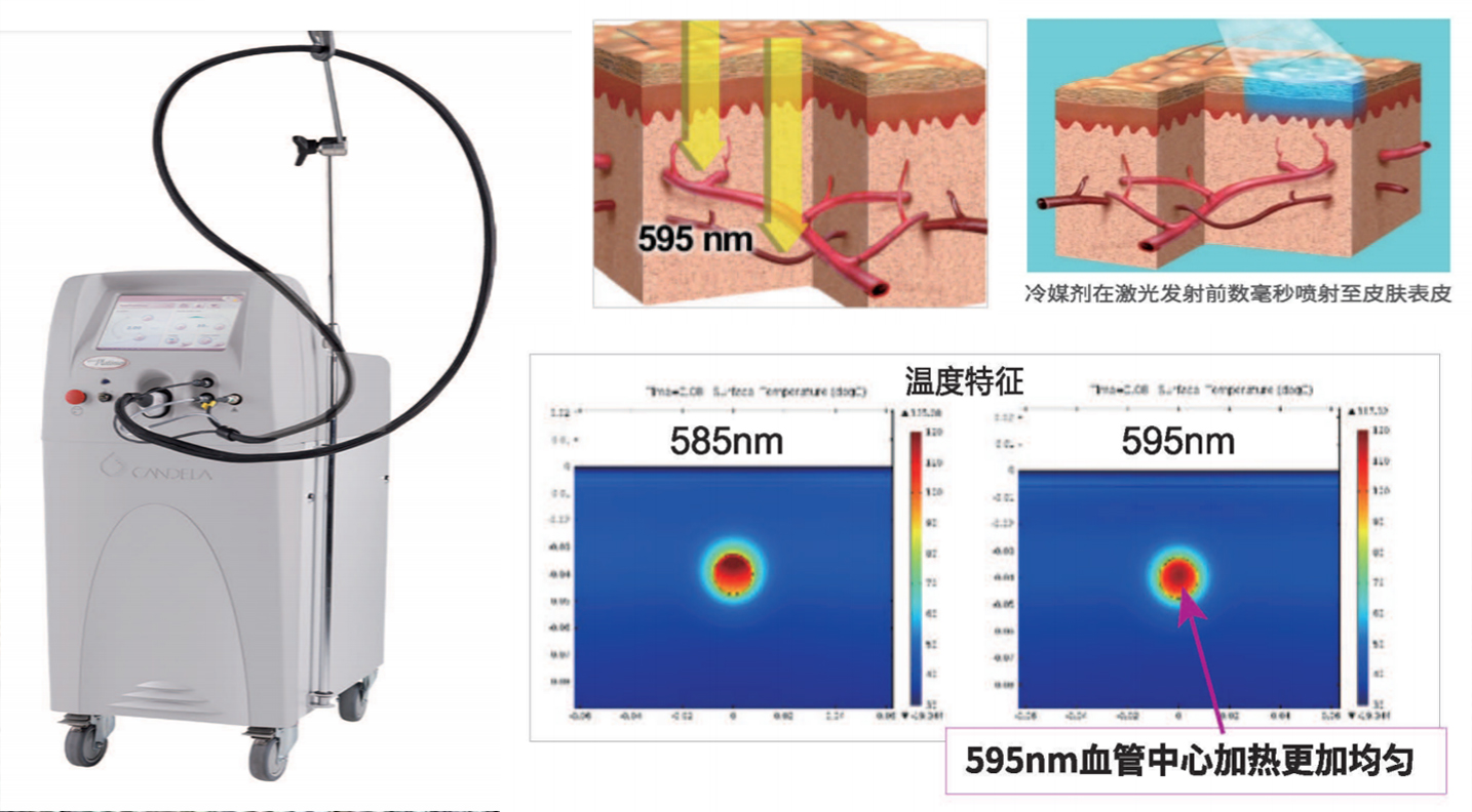 Vbeam595nm脈沖染料激光——鮮紅斑“治”的金標(biāo)準(zhǔn)