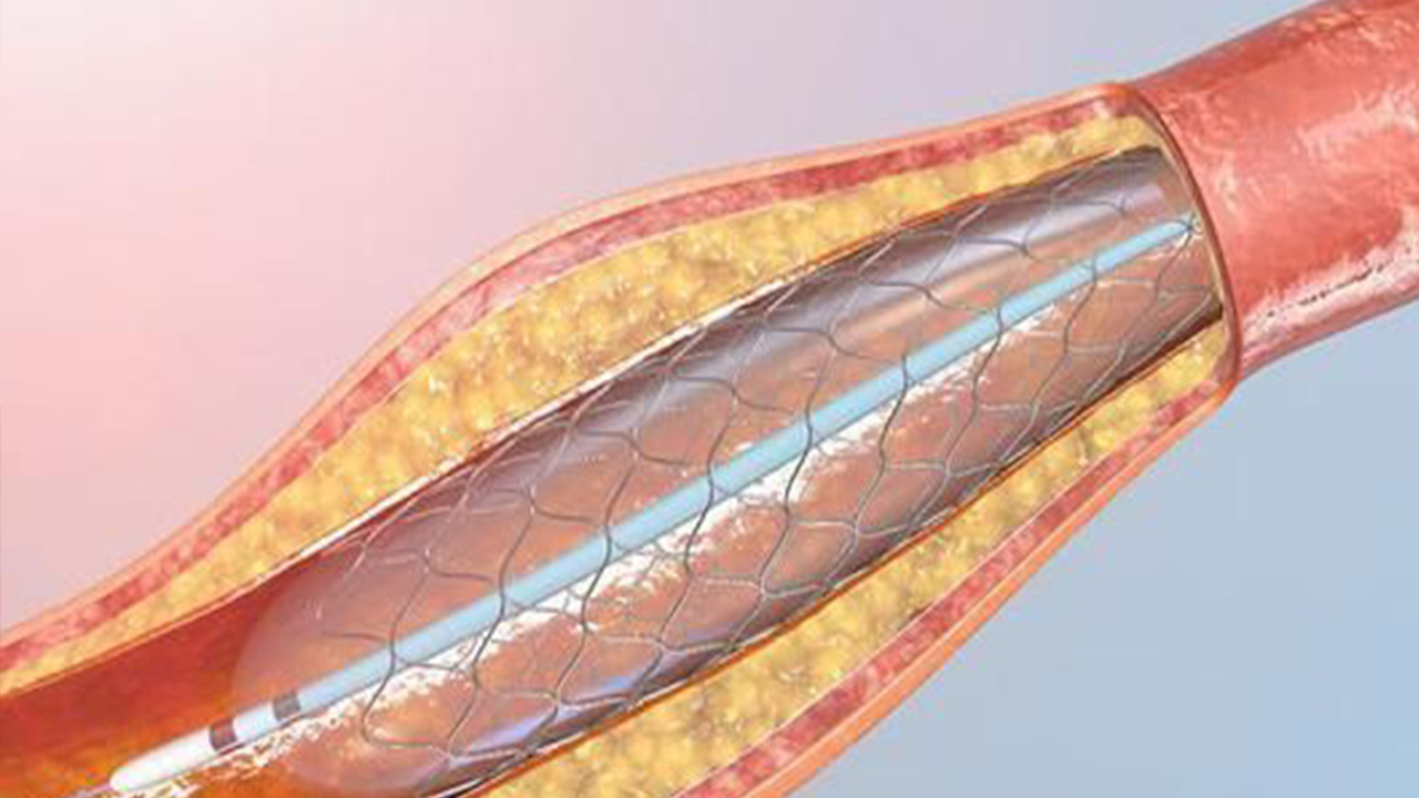 國家組織冠脈支架集采接續(xù)采購開標，價格總體平穩(wěn)—— 產(chǎn)品更加豐富  供應(yīng)更